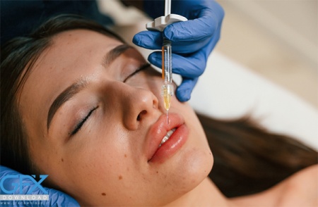 عکس از تزریق ژل لب